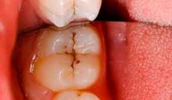 Que es una Caries?