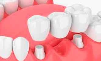 ¿Cómo puedo reemplazar mis dientes perdidos? Puentes Dentales, Implantes Dentales y Dentaduras Postizas