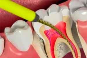 ¿Que implica el tratamiento del conducto radicular?
